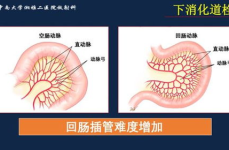 消化道出血能治好吗,治疗与康复之路